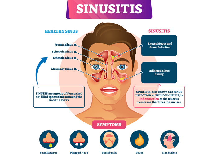 Allergic deals sinusitis medicine