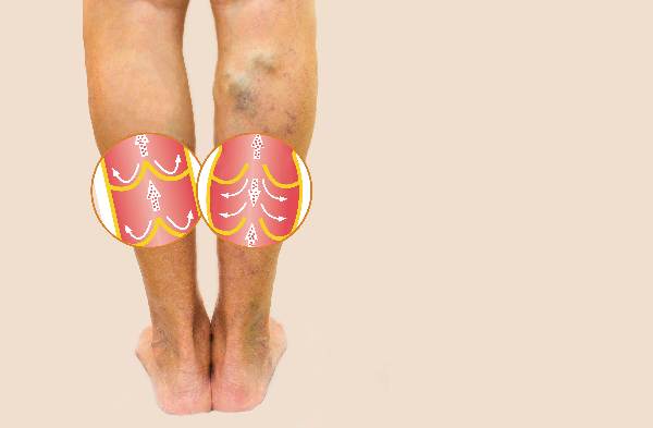 How to Prevent Varicose Veins Before They Start