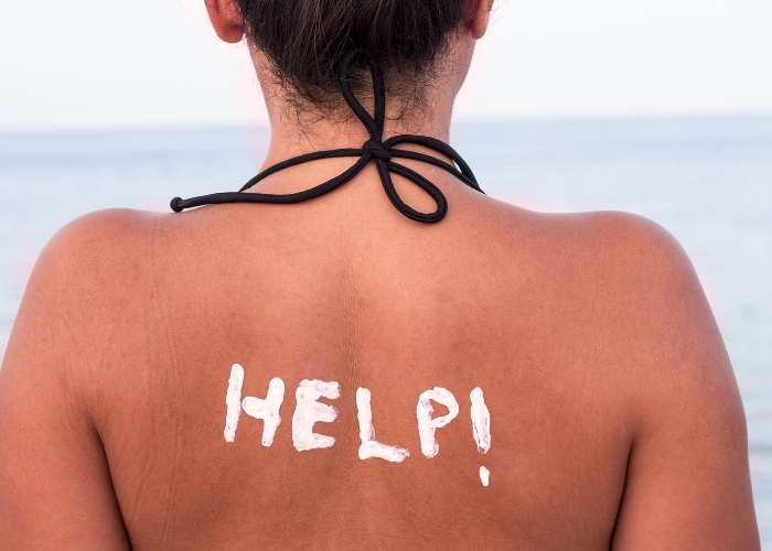 How to treat sunburn naturally