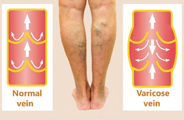 what-do-varicose-veins-look-like