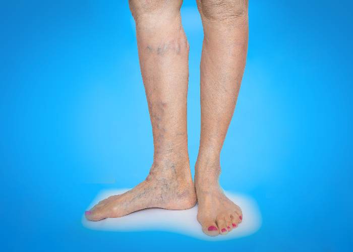 What do varicose veins look like? 