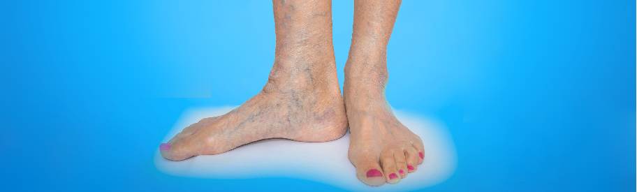 4 ways to prevent varicose veins naturally