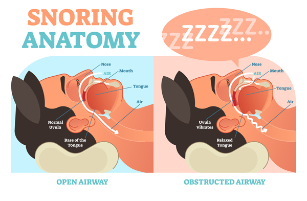 5 Surprising Reasons Why You Could Be Snoring