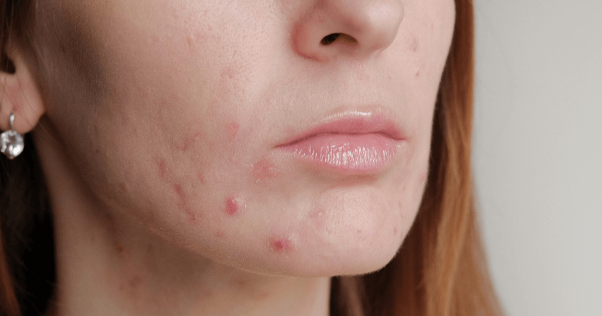 Is acne a menopause symptom? | A.Vogel Talks Menopause